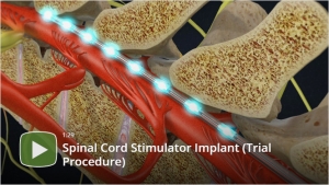 Spinal Cord Stimulation Universal Spine And Joint Specialists